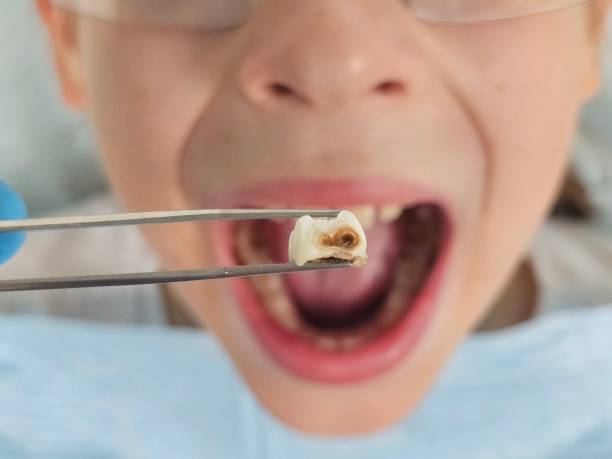 Best Urgent Tooth Repair  in Mckinley, PA